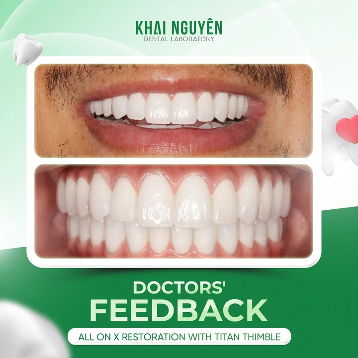 All-on-X restoration on titanium thimbles, clinical feedback from Paris Dental