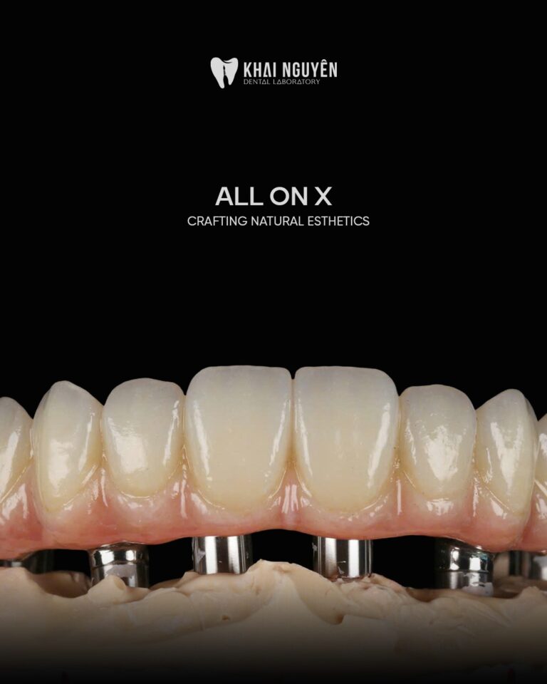 Full-arch All-on-X restoration on multi-unit abutments, Khai Nguyen Dental Lab