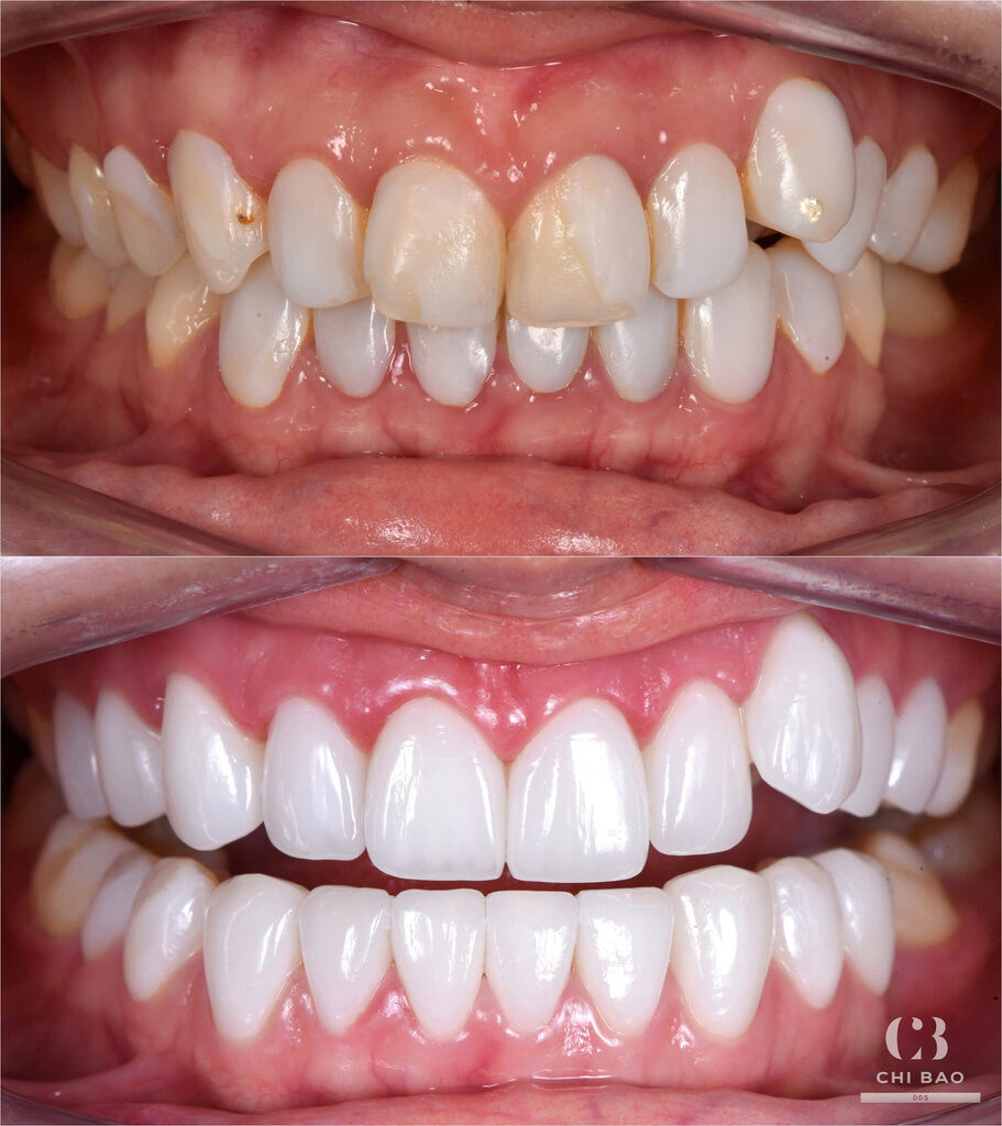 Trước và sau khi thay mặt dán composite cũ bằng 20 veneer e.max, ảnh BS.CKI Trương Chí Bảo
