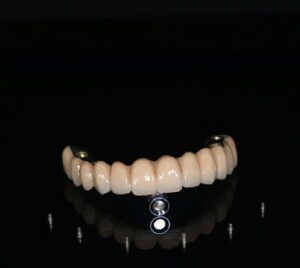 Phục hình toàn hàm FP1 trên 6 implant AnyRidge, mặt ngoài