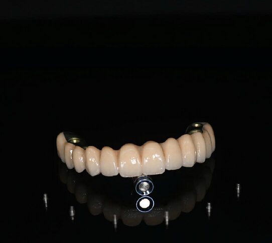 Phục hình toàn hàm FP1 trên 6 implant AnyRidge, mặt ngoài