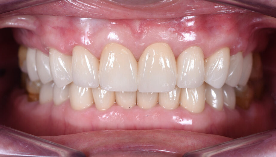 Sau điều trị: 20 mão ZirCAD Prime răng trước trên kích thước dọc mới