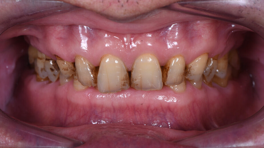 Trước điều trị: răng mòn, vỡ, chiều cao khớp cắn giảm