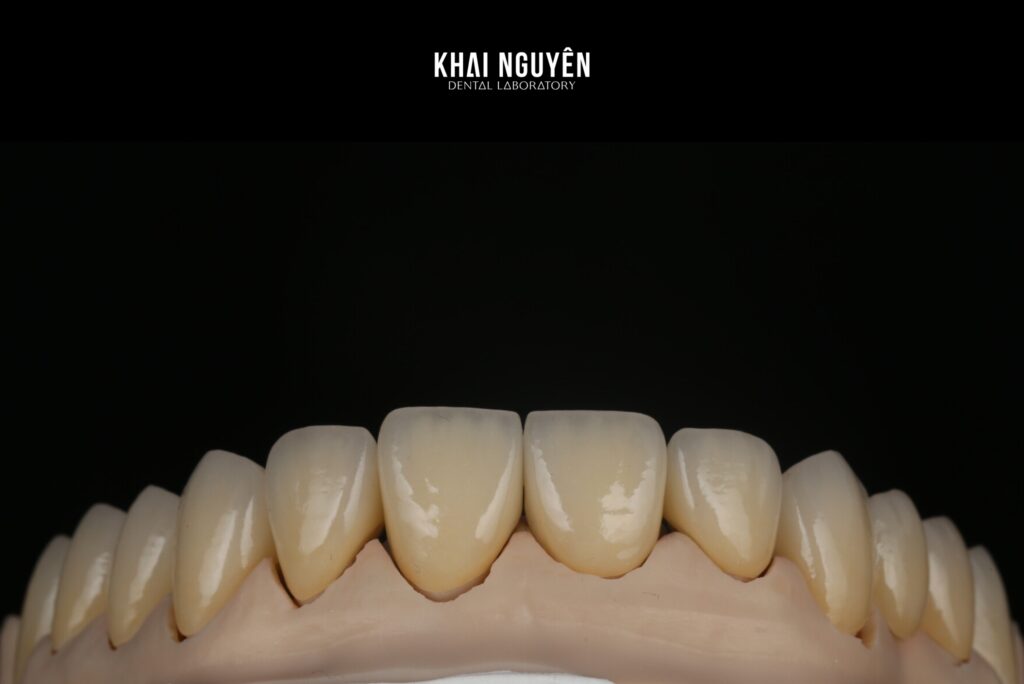 Twelve-unit ZirCAD Prime zirconia bridge and crowns, shade A3 to A3.5, frontal view
