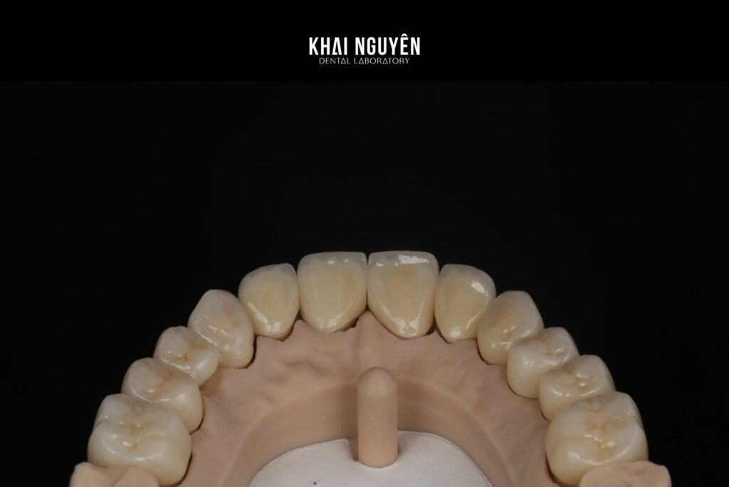 Twelve-unit zirconia restoration, occlusal view on the model