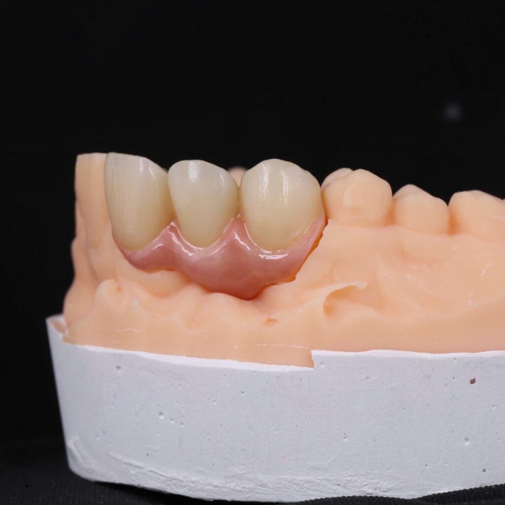 Three-unit zirconia bridge teeth 11 to 13, lateral view on the model