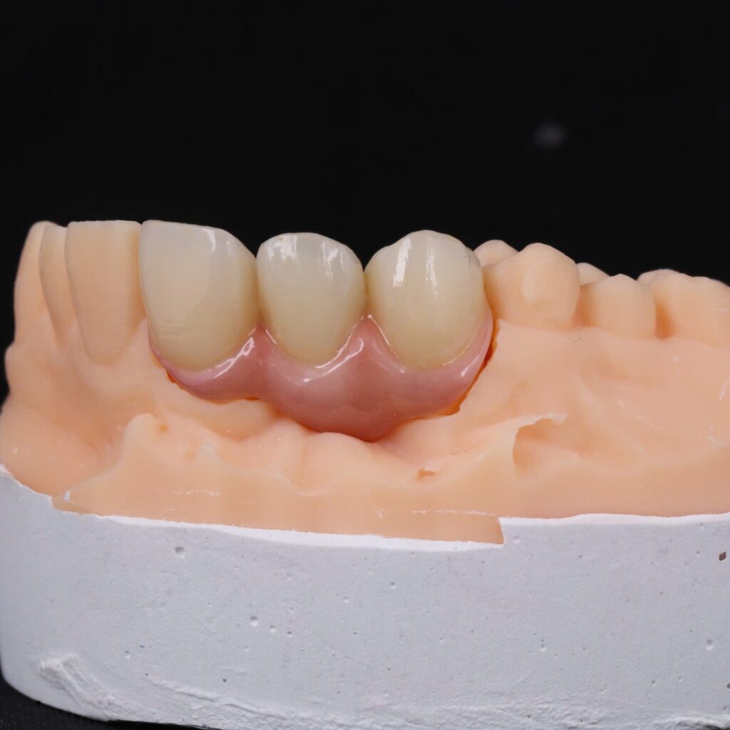 Three-unit IPS e.max ZirCAD Prime bridge, teeth 11 to 13, shade A2, cut-back and layered, on the model