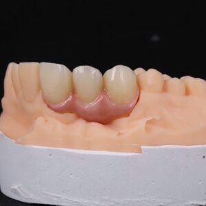 Three-unit IPS e.max ZirCAD Prime bridge, teeth 11 to 13, shade A2, cut-back and layered, on the model
