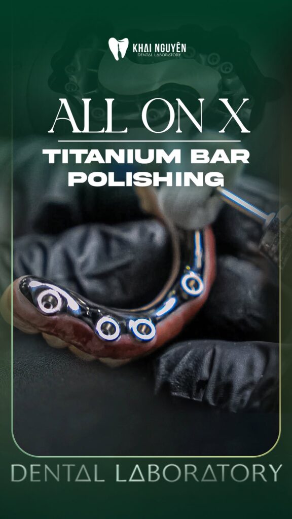 Đánh bóng thanh bar titan dưới nướu trong ca All-on-X tách iBar, Khai Nguyên Dental Lab