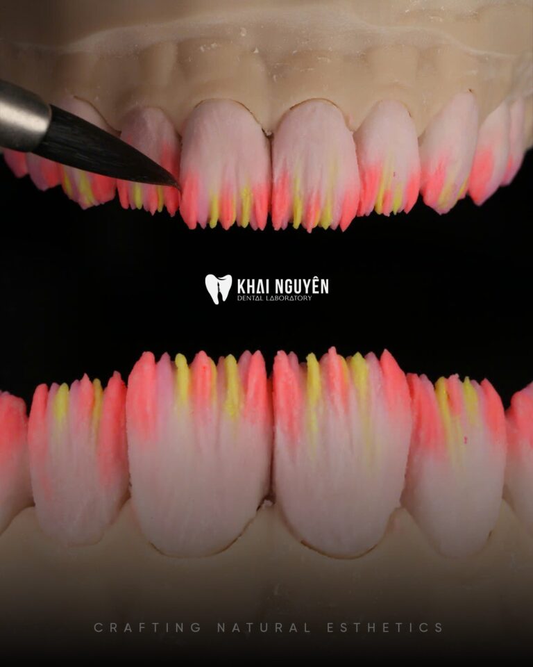 Effect porcelains applied to anterior veneers before firing, colour mapping