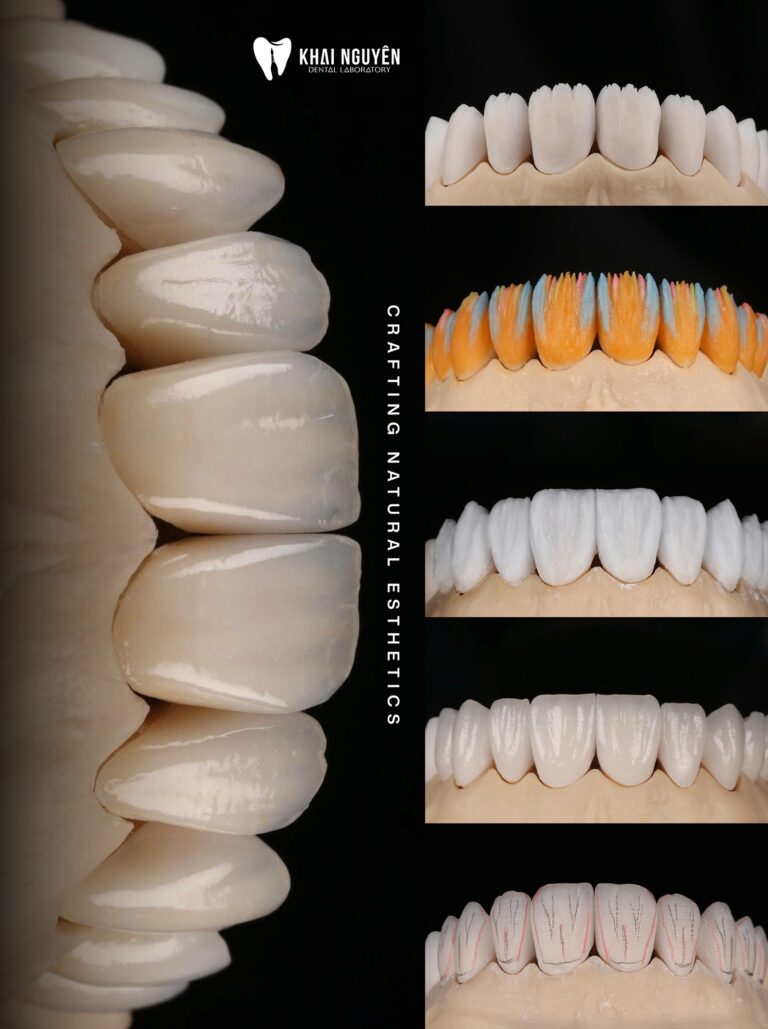 Layering sequence of anterior veneers: internal effects, dentin and enamel build-up, final texture, Khai Nguyen Dental Lab