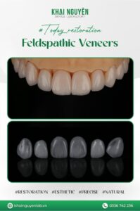 Ca feldspathic 10 răng, tái tạo hiệu ứng trong mờ như men răng thật
