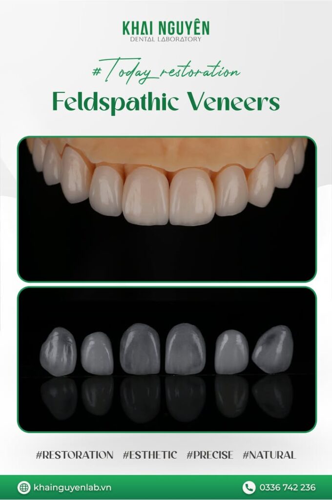 Ca feldspathic 10 răng, tái tạo hiệu ứng trong mờ như men răng thật