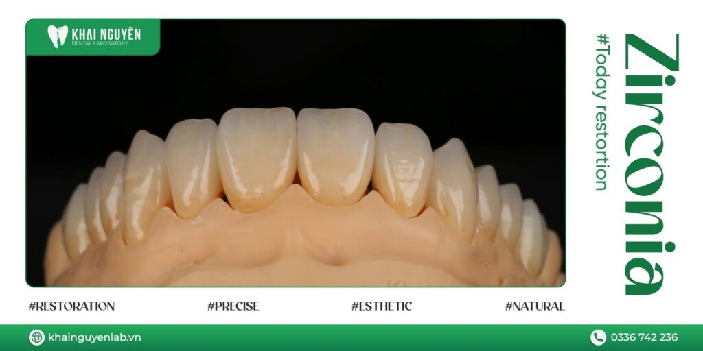 Phục hình Multi Zirconia kỹ thuật full-cutback đắp sứ mặt ngoài