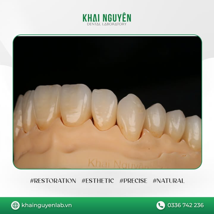 Phục hình Multi Zirconia kỹ thuật full-cutback đắp sứ mặt ngoài