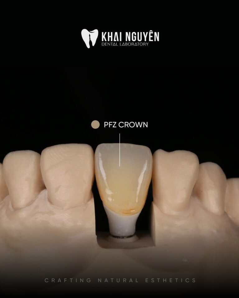 Custom hybrid abutment with porcelain-fused-to-zirconia crown on the model