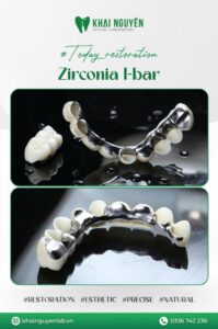 Khung I-bar kim loại kết hợp mão zirconia cho cầu dài