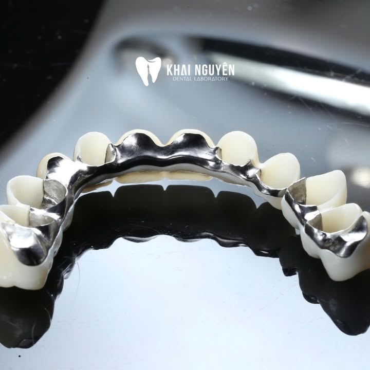 Khung I-bar kim loại kết hợp mão zirconia cho cầu dài