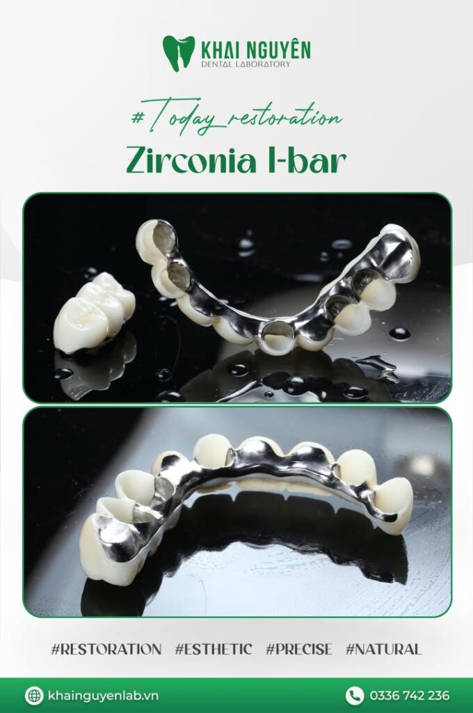 Khung I-bar kim loại kết hợp mão zirconia cho cầu dài