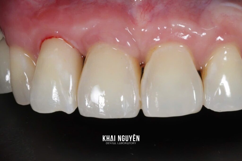 Zirconia crown on a custom hybrid abutment, implant at tooth 11, 3M Lava shade A2, intraoral view after seating