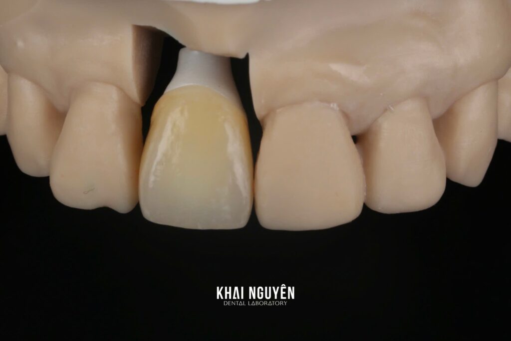 Zirconia crown on the hybrid abutment seated on the model with soft-tissue mask, tooth 11