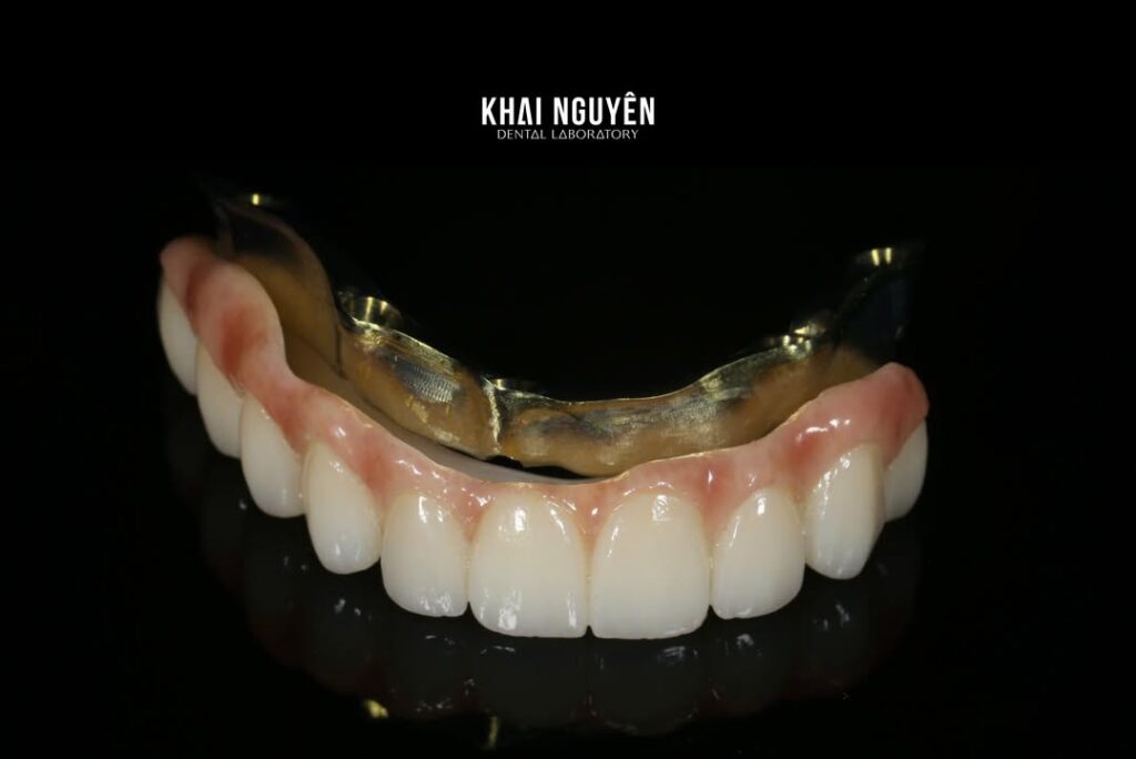 Phục hình implant trên thanh bar