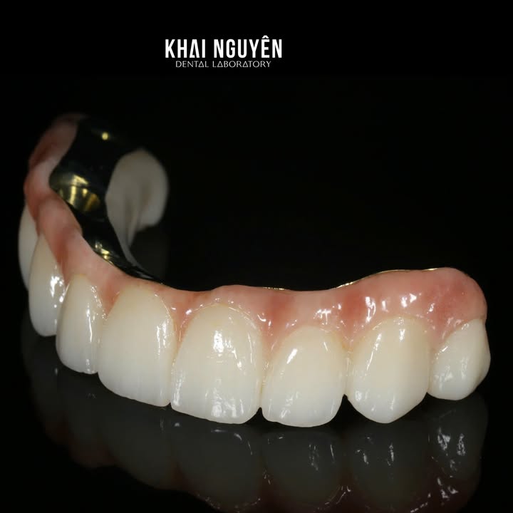 Phục hình implant trên thanh bar