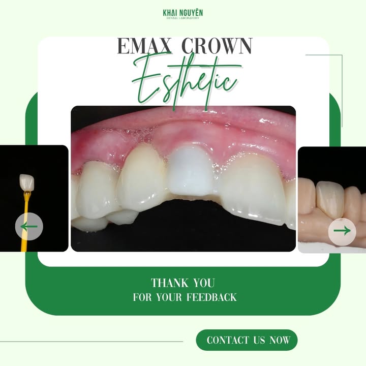 Single IPS e.max crown on an upper anterior tooth between natural neighbours