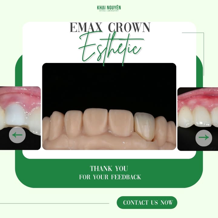 The same e.max crown on the model before delivery