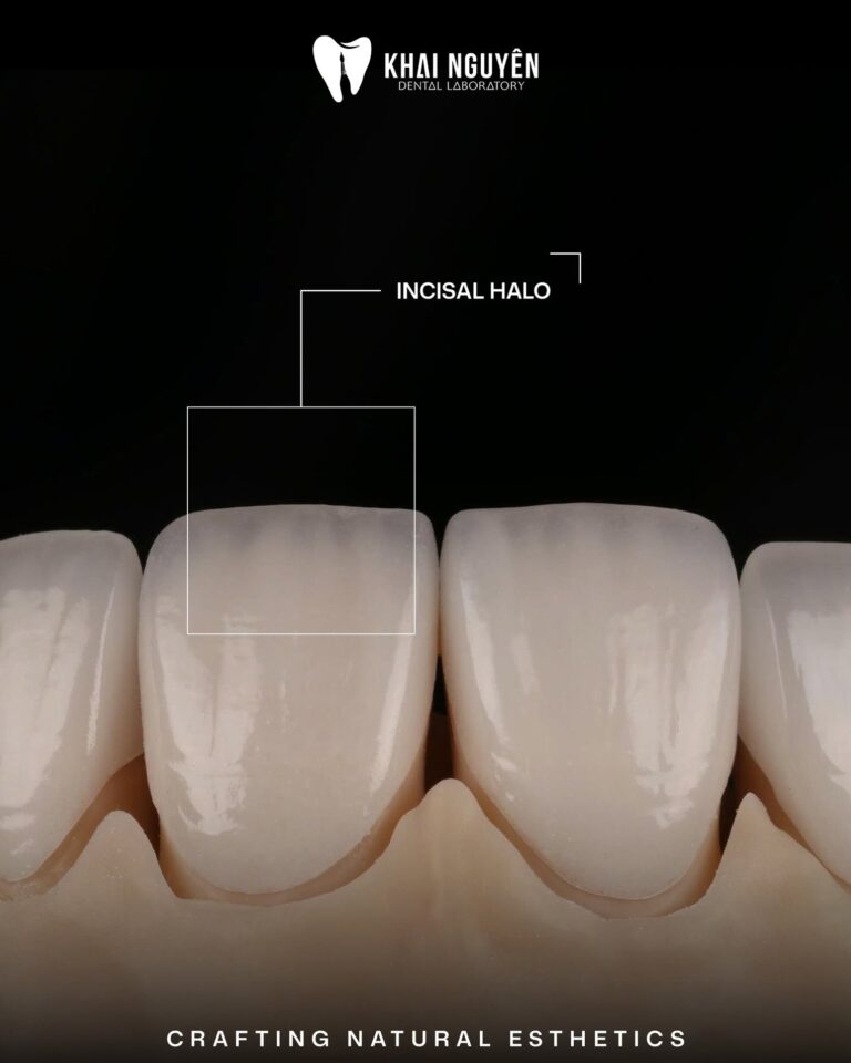 IPS e.max crown and feldspathic veneers shade OM1 showing the incisal halo, Khai Nguyen Dental Lab