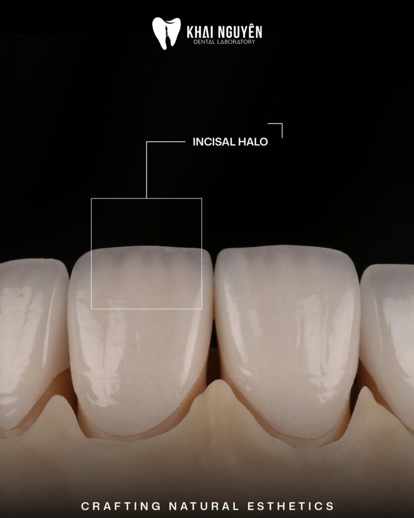 IPS e.max crown and feldspathic veneers shade OM1 showing the incisal halo, Khai Nguyen Dental Lab