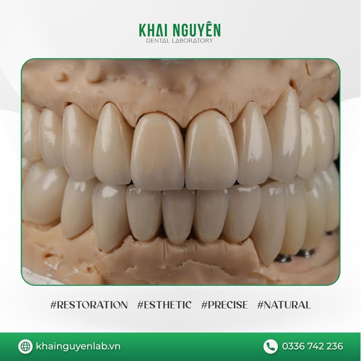 Ca nâng khớp toàn hàm kết hợp veneer, onlay, mão và phục hình trên implant