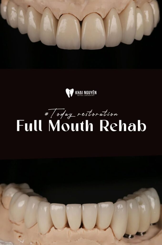 Ca nâng khớp toàn hàm kết hợp veneer, onlay, mão và phục hình trên implant