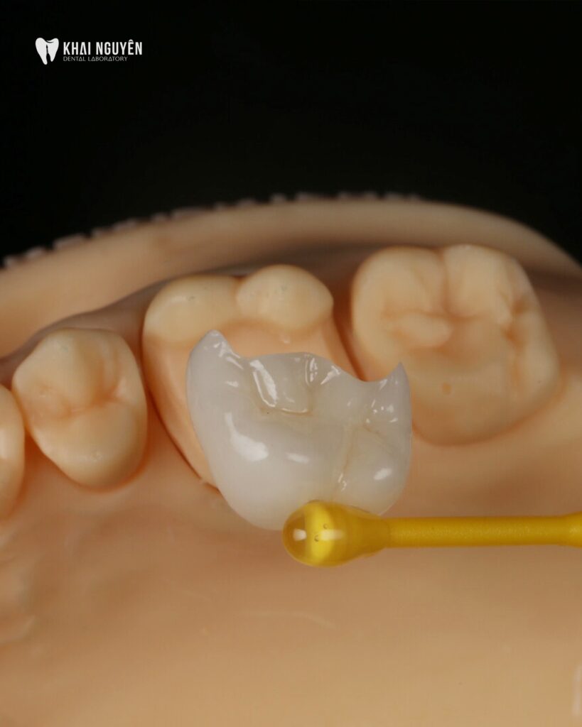 Ceramic overlay seated on the model at Khai Nguyen Dental Lab, showing the marginal fit against the adjacent teeth