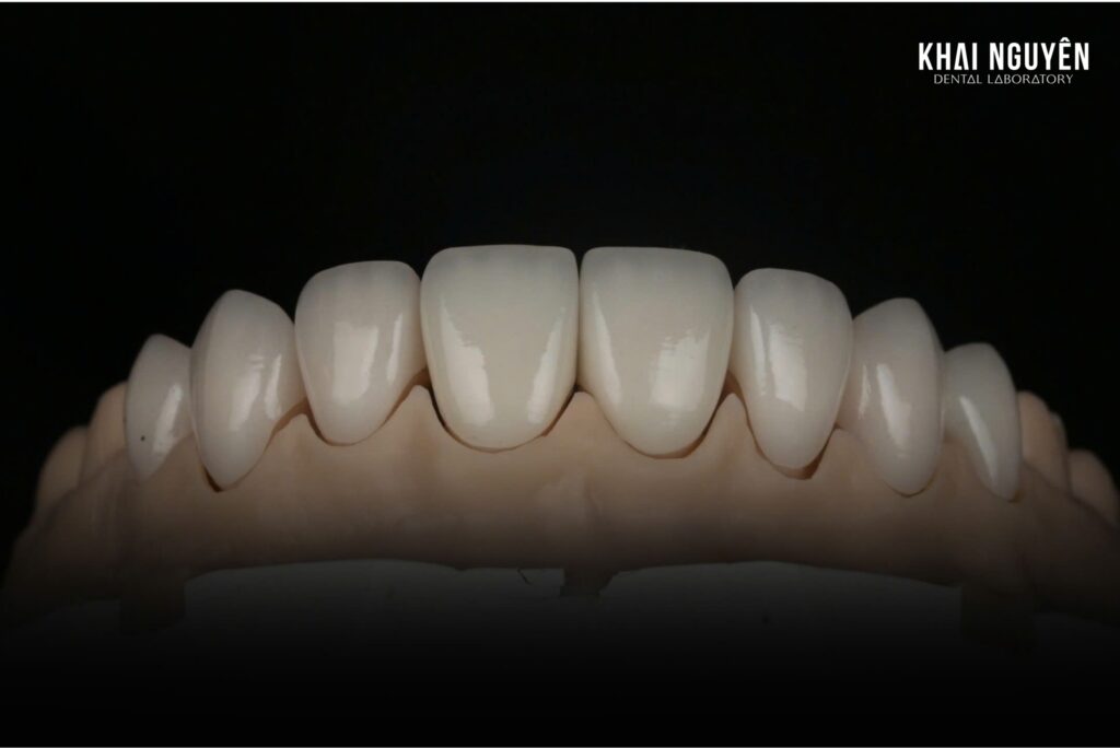 Combined case: e.max Press veneers 14 to 24 with ZirCAD Prime zirconia crowns 11 to 21, frontal view
