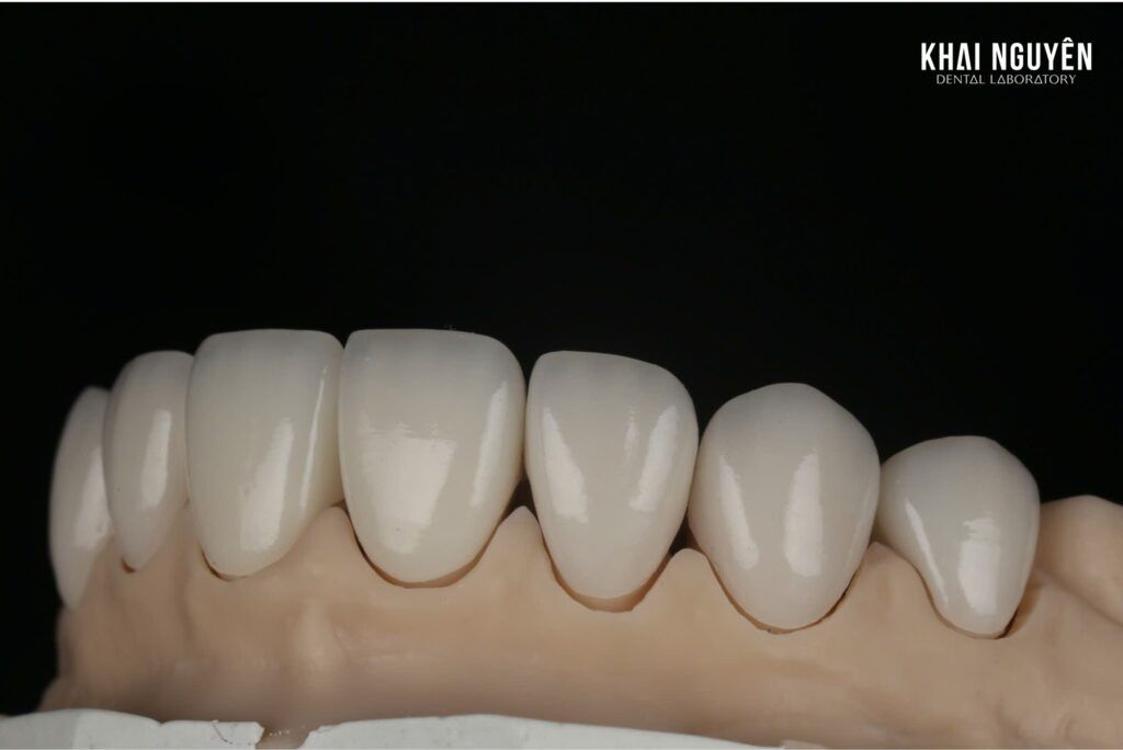 Combined veneers and zirconia crowns case, right lateral view on the model