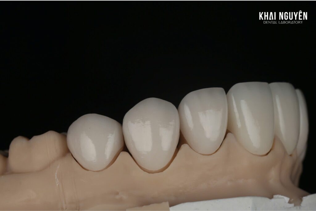 Combined veneers and zirconia crowns case, left lateral view on the model