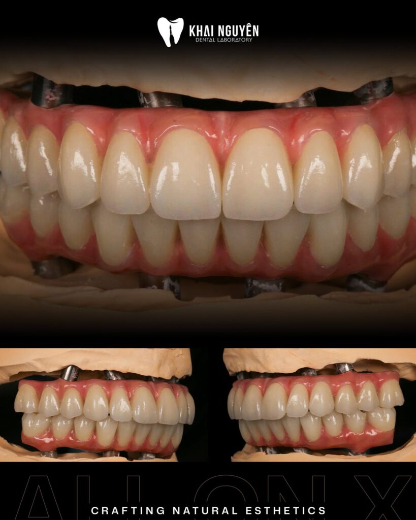 All-on-X full-arch upper and lower restorations with custom gingival ceramics on the model, Khai Nguyen Dental Lab