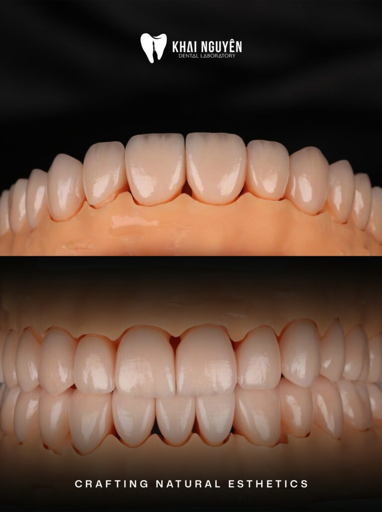 Full-mouth rehabilitation with upper and lower e.max veneers on the model
