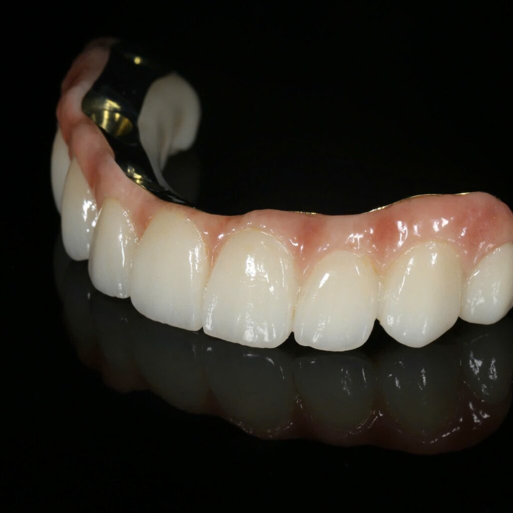 Full-arch zirconia overlay on a CAD/CAM iBar, Aidite 3D Pro, frontal view with pink gingival ceramics