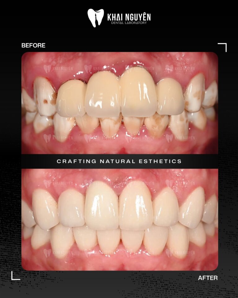 Before and after: old anterior crowns replaced with a combination of zirconia crowns and porcelain veneers, Khai Nguyen Dental Lab