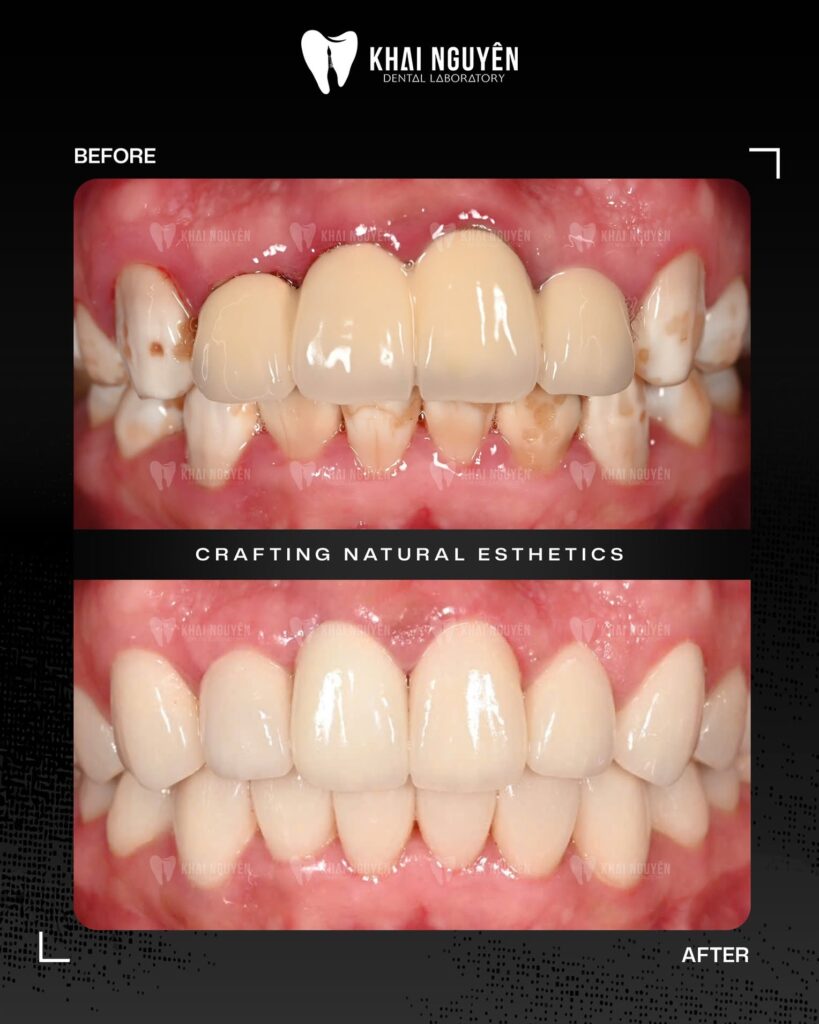 Before and after: old anterior crowns replaced with a combination of zirconia crowns and porcelain veneers, Khai Nguyen Dental Lab