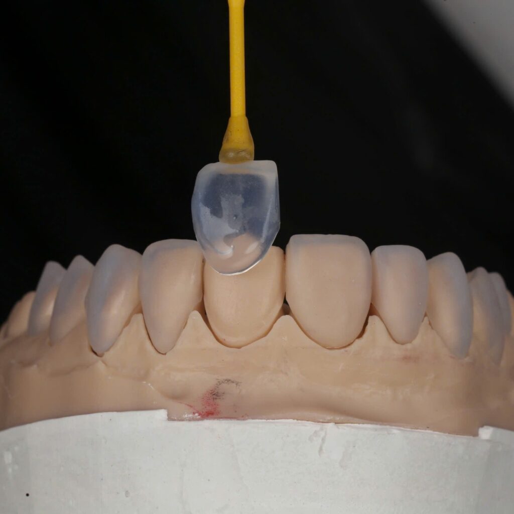 Single veneer on a holding stick over the model, ten-unit Amber Mill veneer case