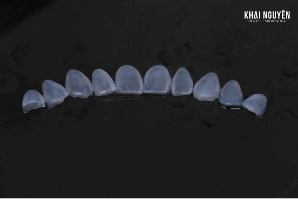 Veneer 10 răng hàm trên bằng Amber Mill, màu 1M1 đến 1M2