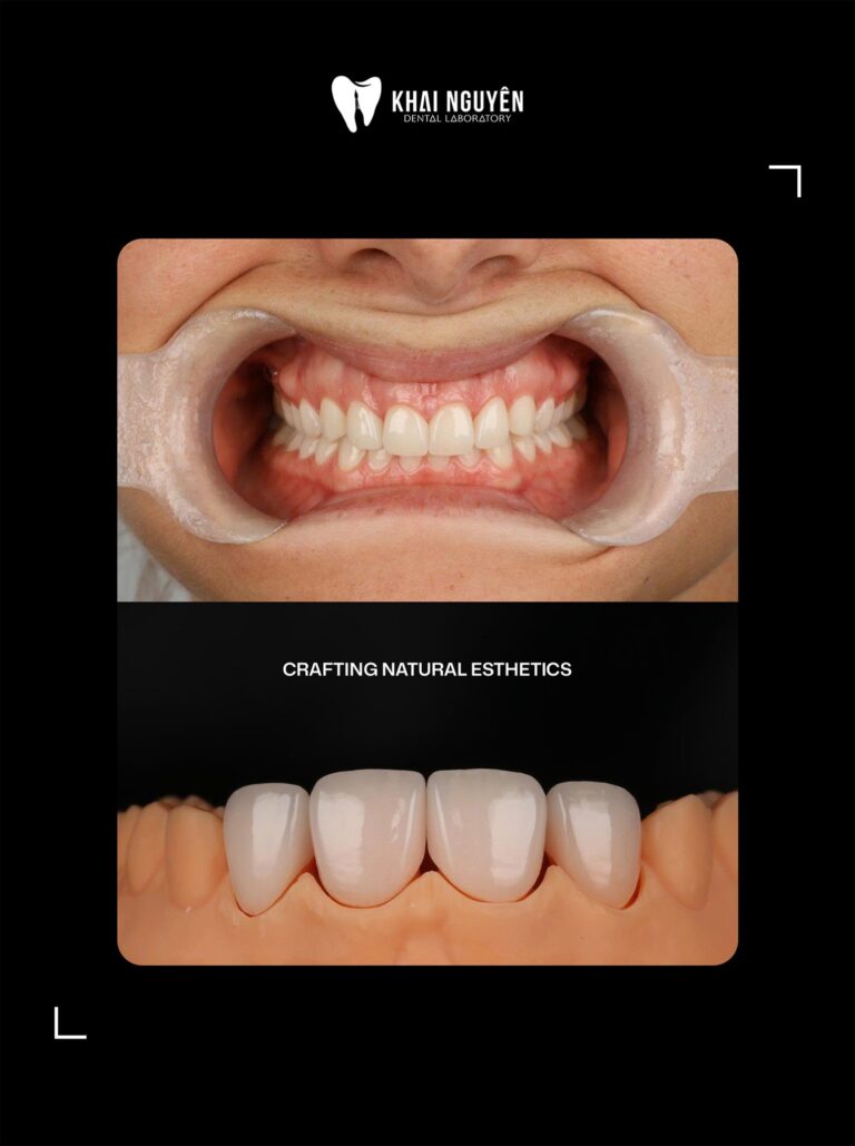 Before and after: four-unit veneer case teeth 12 to 22, Khai Nguyen Dental Lab