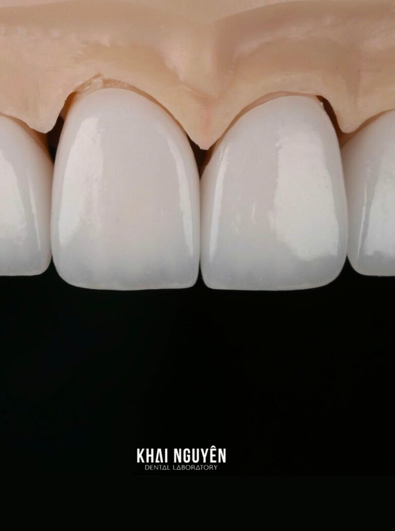 Eight-unit esthetic veneer case, close-up of natural incisal edges