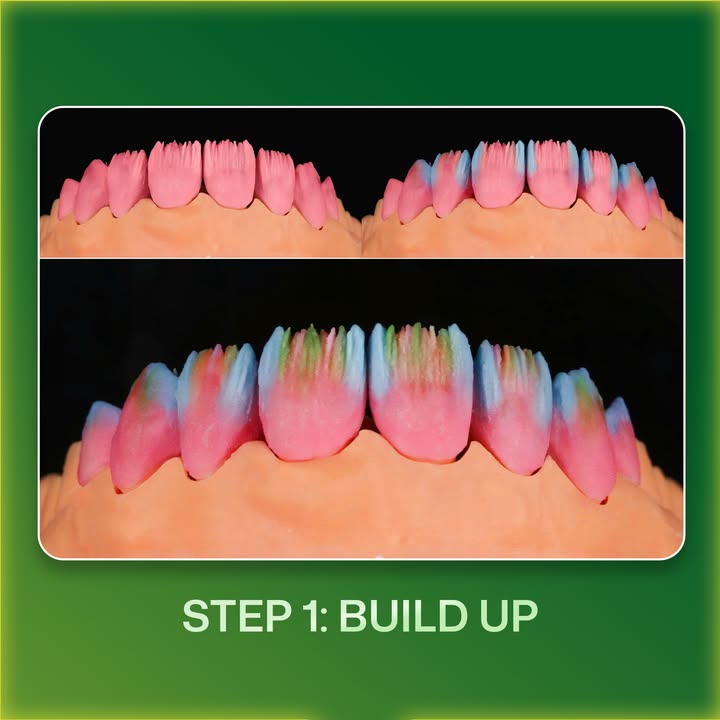 Bước đắp sứ hiệu ứng nhiều màu trên veneer trước khi nướng, Khai Nguyên Dental Lab