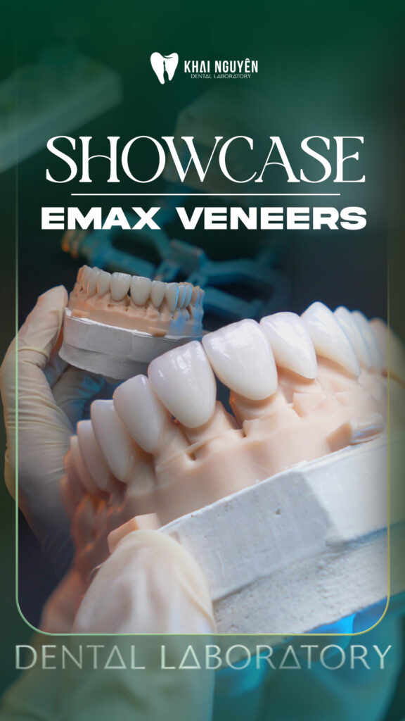 Veneer e.max trên nền cùi tối màu A4 được nâng lên màu 1M1 bằng thỏi e.max MO và sườn đắp sứ