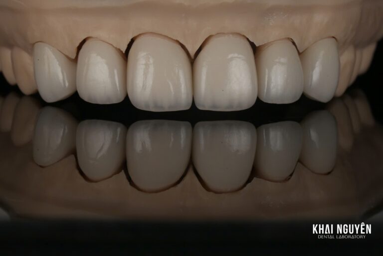IPS e.max Press veneers shade 1M1, one of the lab's signature veneer cases, on the model