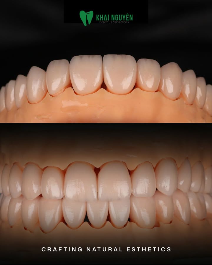 Full-arch IPS e.max veneers in shade 1M2 on ND2 preparations, Khai Nguyen Dental Lab